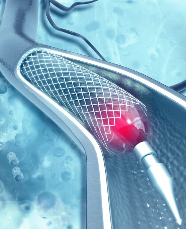 低侵襲治療(Stent graft、MIDCABなど)